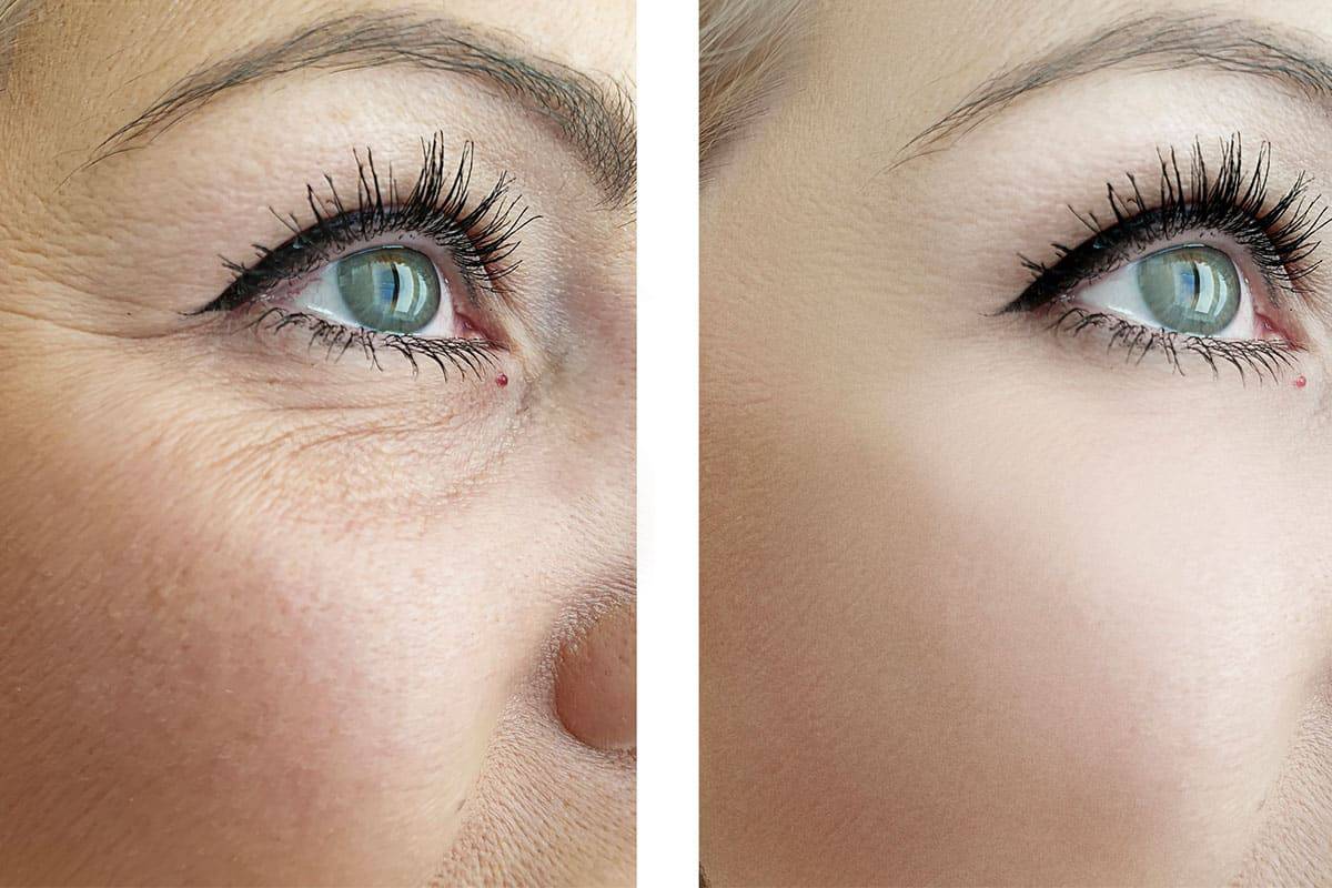Eye Rejuvenation Eye Rejuvenation Before & After Eye Rejuvenation Treatment Photos | LA Ageless Medical Aesthetics in Beverly Hills