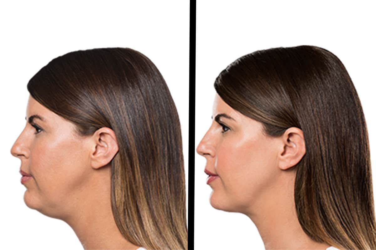kybella Before & After Treatment Photos | LA Ageless Medical Aesthetics in Beverly Hills