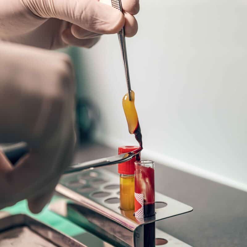 Platelet-Rich Fibrin by LA Ageless Medical Beverly Hills, CA